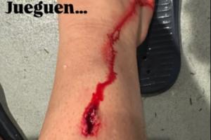 被林德洛夫出球后踢到小腿，毕尔巴鄂中场晒伤口：没红黄牌没犯规